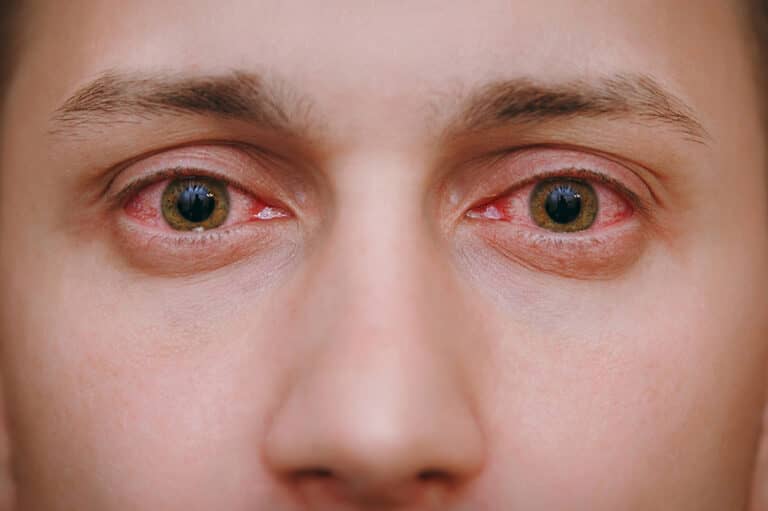 yeux rouges irrités vr