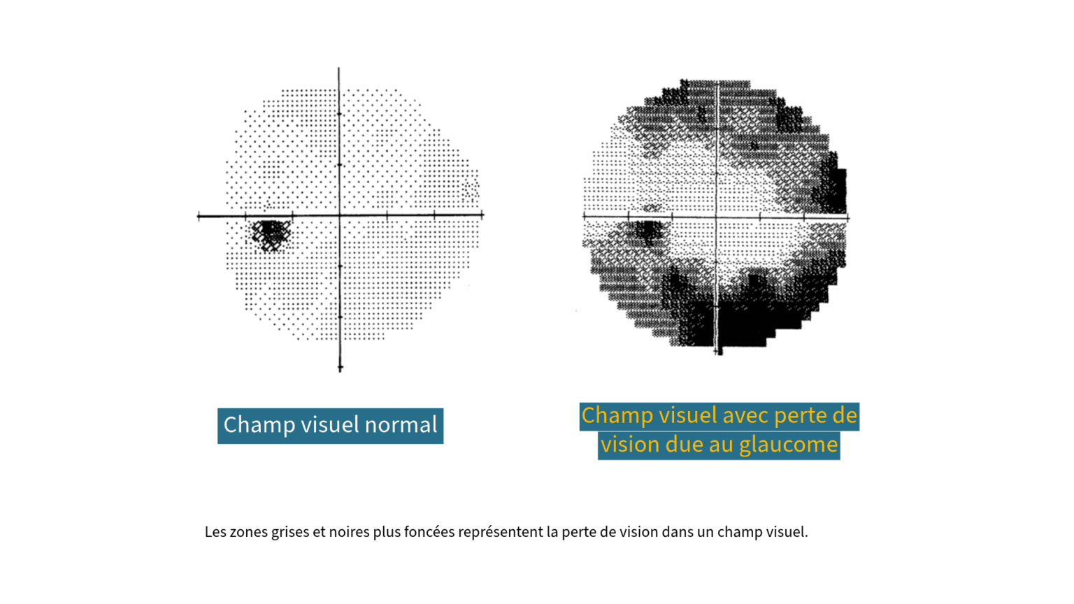 resultat-champ-visuel