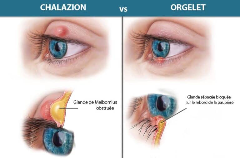 difference-chalazion-orgelet