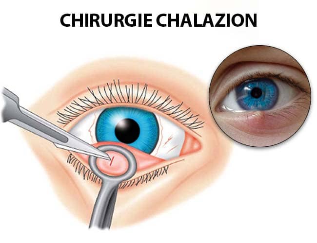 chirurgie-chalazion